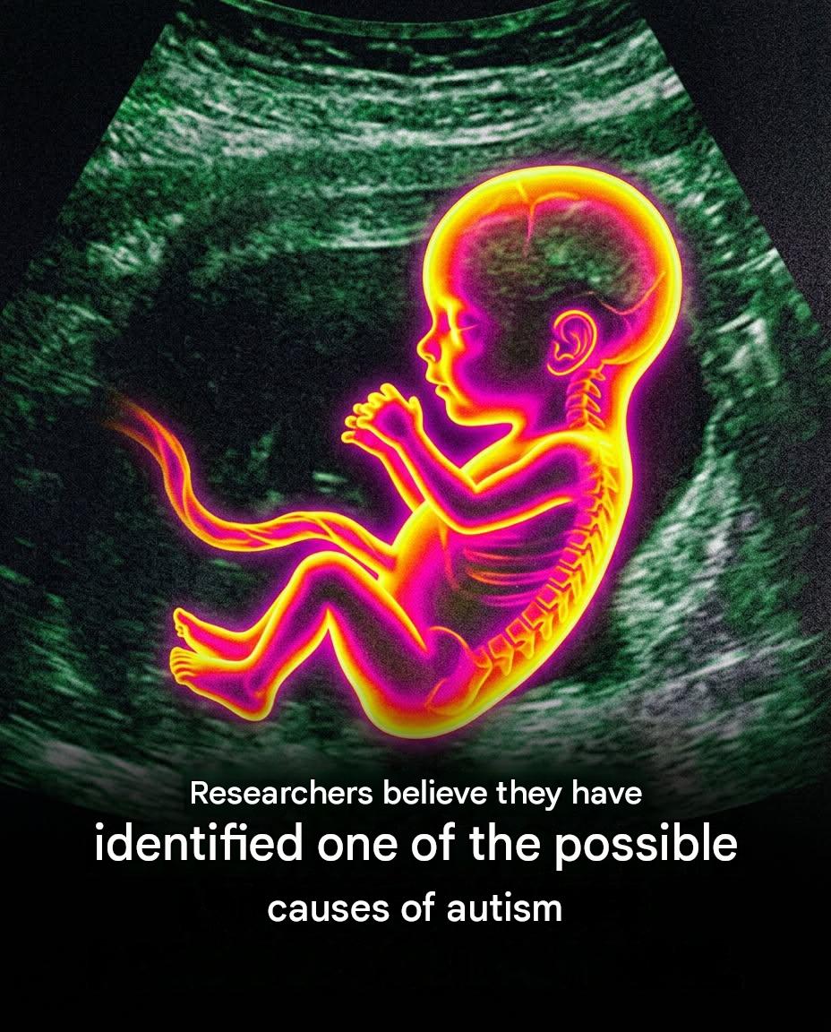 Autism: What if the mother’s intestinal balance during pregnancy played an unsuspected role?
