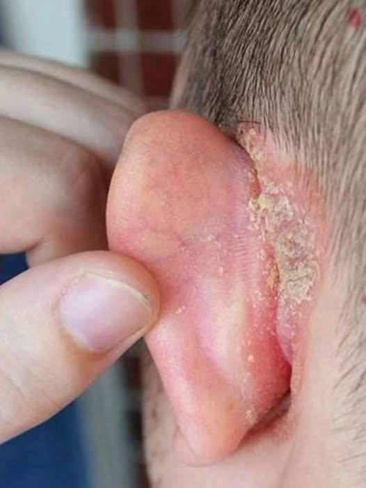 I found a strange patch of skin on my son’s ear this morning. His doctor appointment is a week away — what should I do meanwhile? Full article “